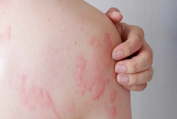 Allergy